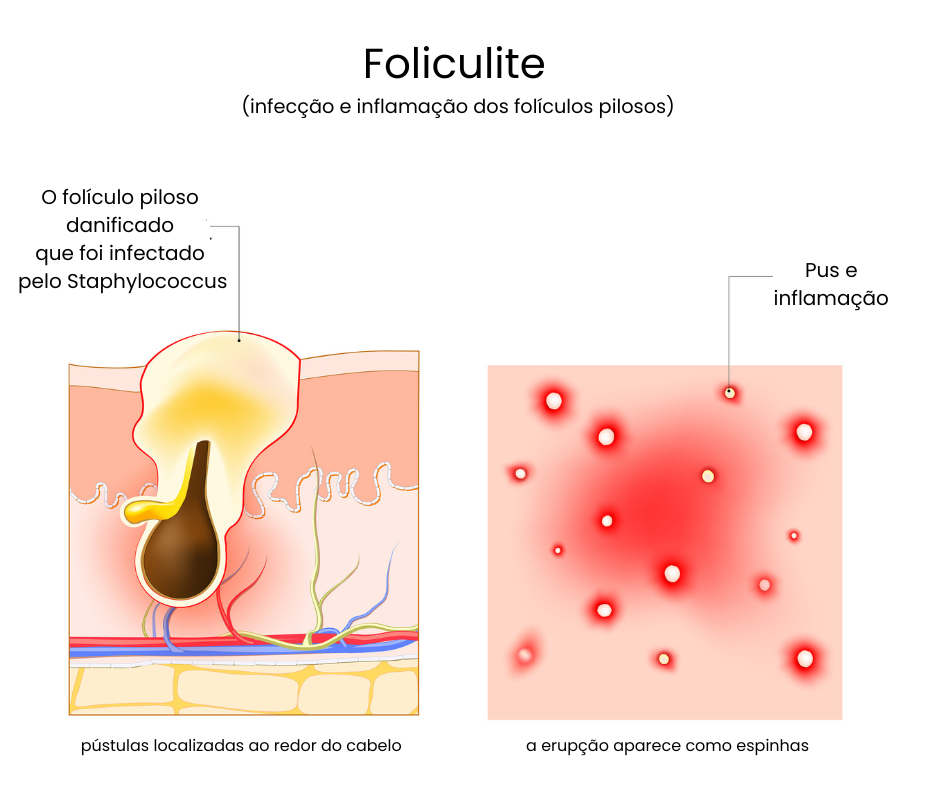 o que é foliculite de rosto