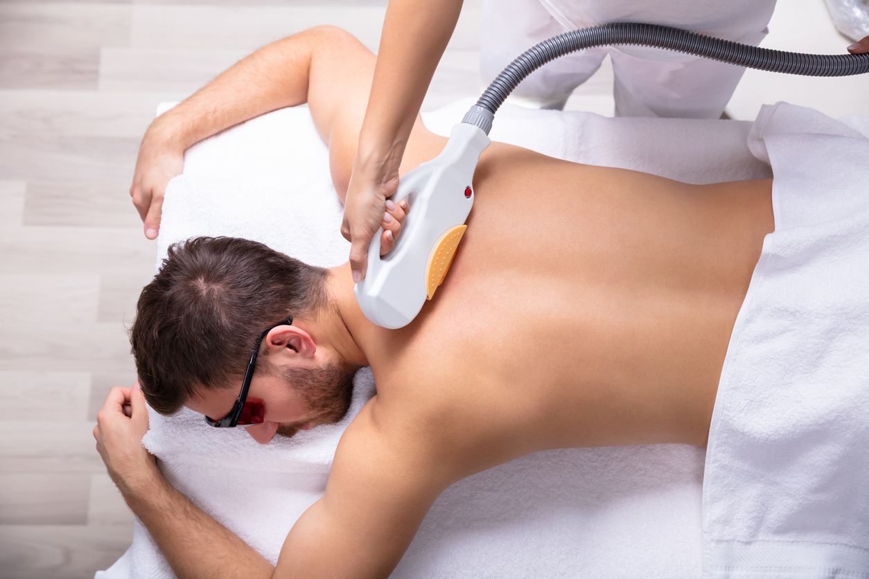 Depilação a laser masculina nas costas